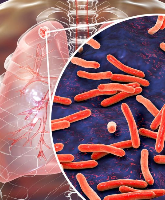 Dlaczego cukrzyca typu 2 zwiększa ryzyko gruźlicy? Poznaj mechanizmy