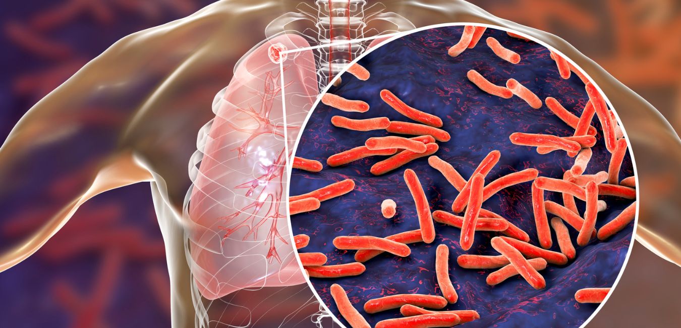 Dlaczego cukrzyca typu 2 zwiększa ryzyko gruźlicy? Poznaj mechanizmy